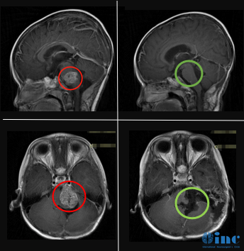 室管膜瘤术前术后影像对比