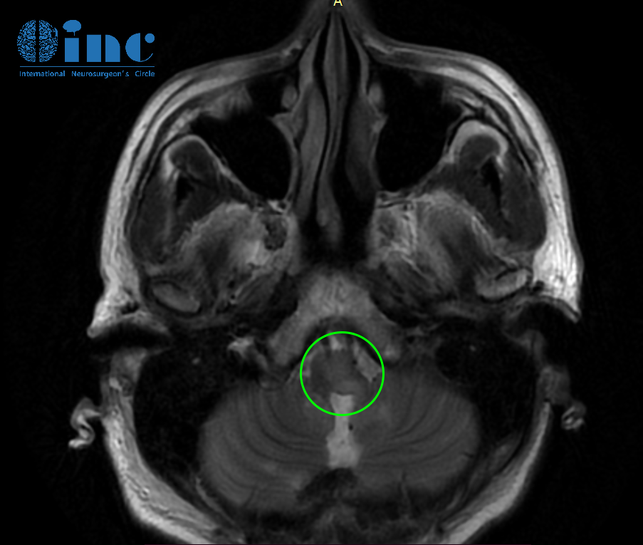 恶性脑干弥漫中线胶质瘤术后影像
