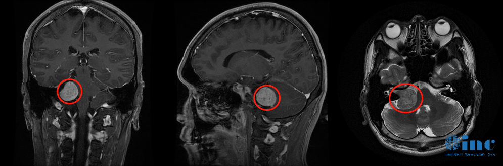 听神经瘤影像