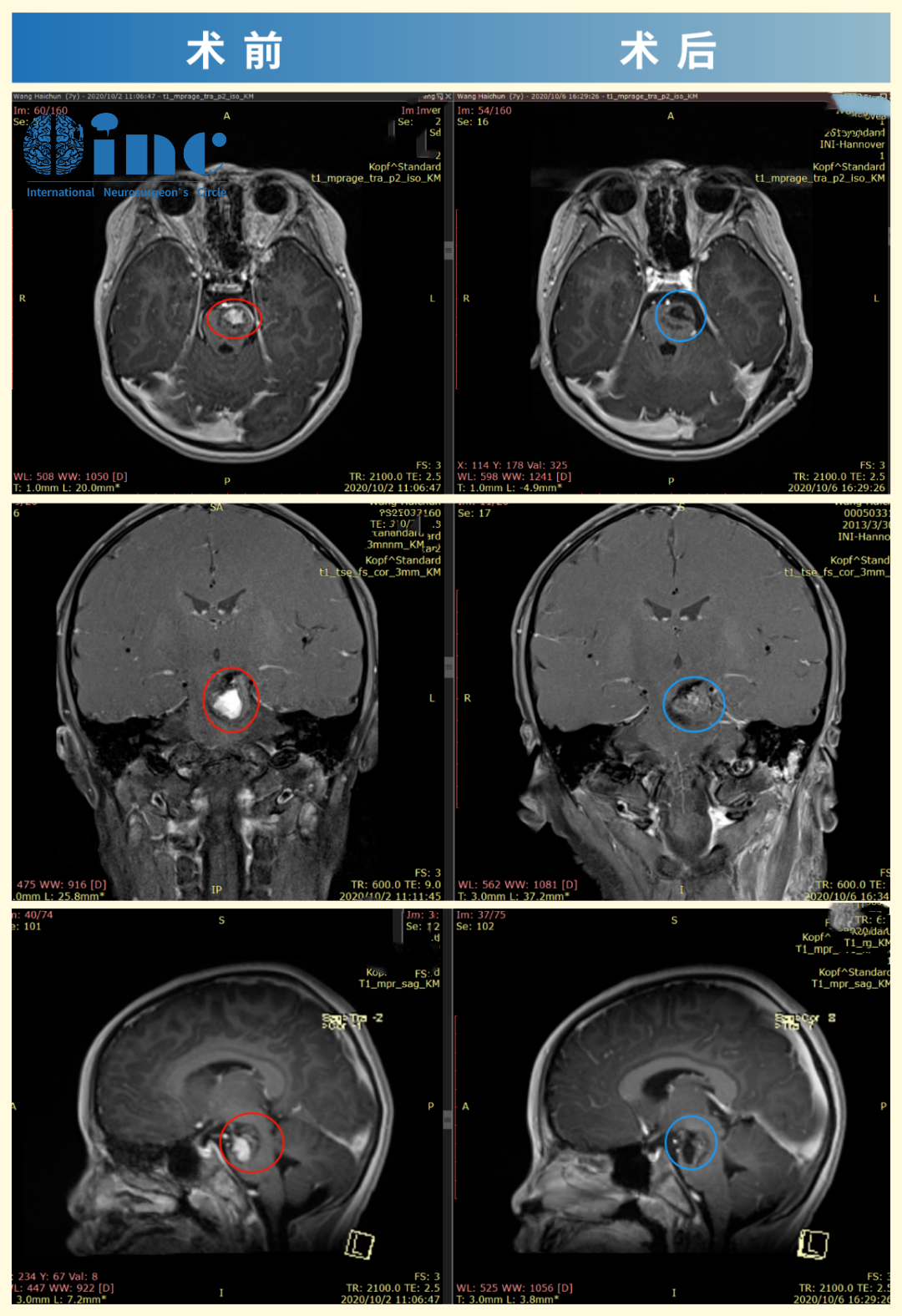 7岁男性桥脑海绵状血管瘤