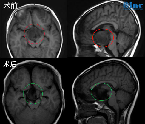 视神经胶质瘤影像