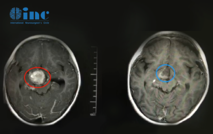 5岁患儿 视神经下丘脑胶质瘤影像