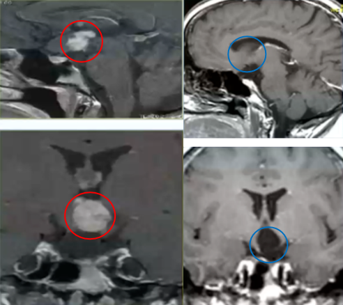 24岁女孩 视神经下丘脑胶质瘤
