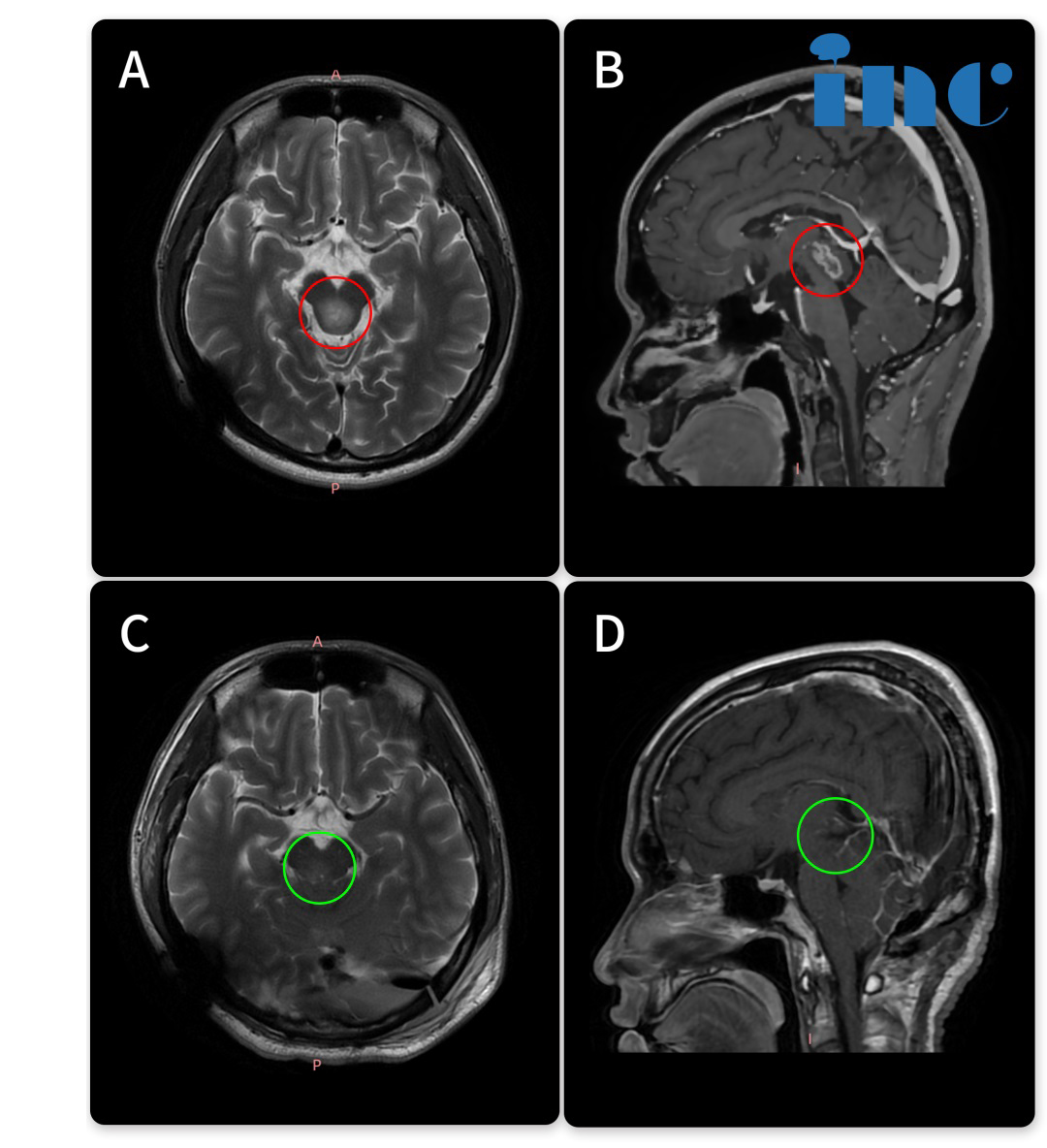 胶质瘤手术影像