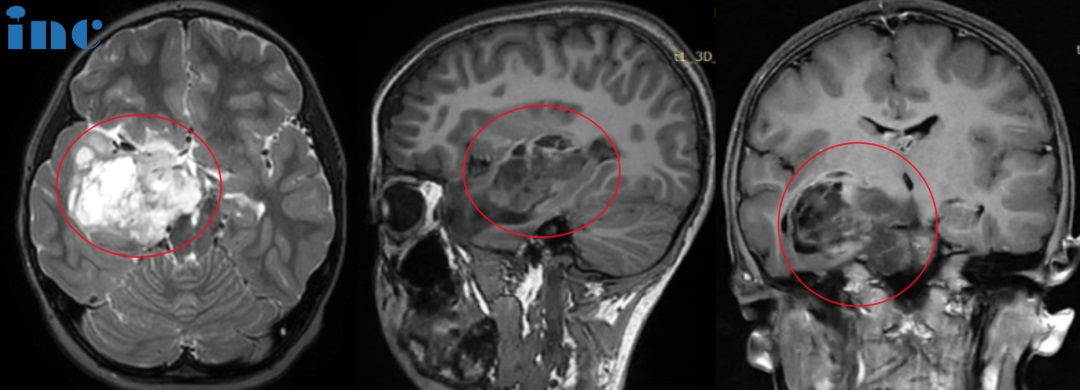 胶质瘤手术影像