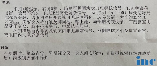 胶质瘤手术治疗