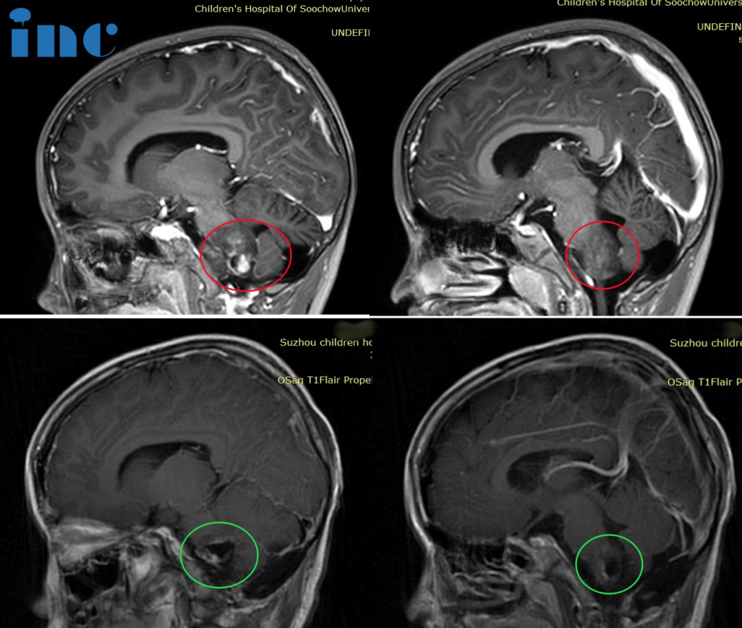 6岁男孩-延髓毛细胞星形细胞瘤