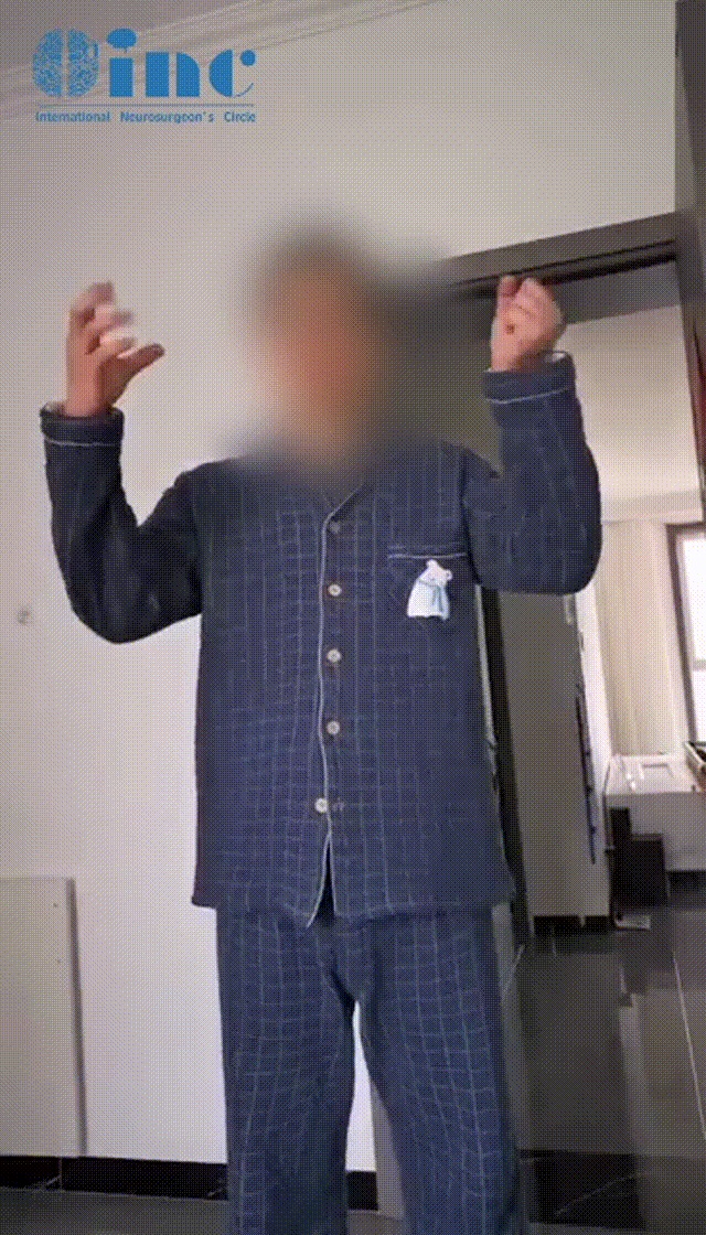 32岁男性-延髓海绵状血管瘤