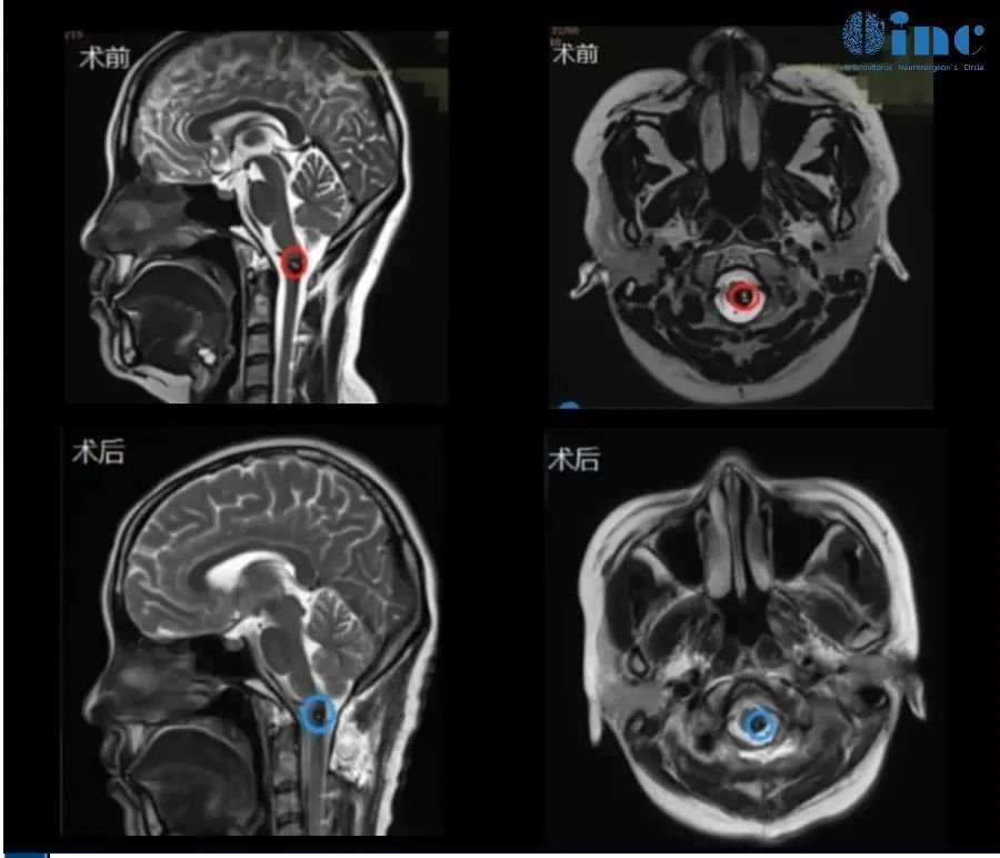 30岁女性-延髓-颈髓海绵状血管瘤