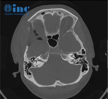 脑膜瘤影像