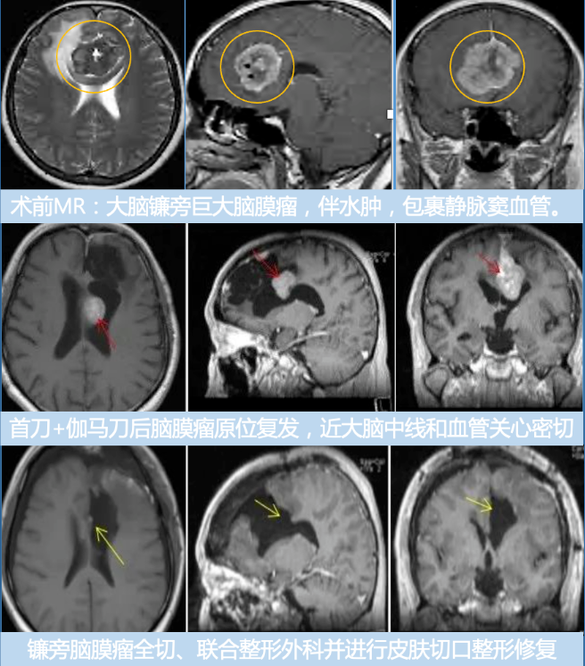 大脑镰旁脑膜瘤术前术后对比