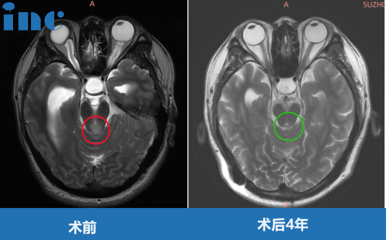 巴教授中脑顶盖胶质瘤示范手术影像