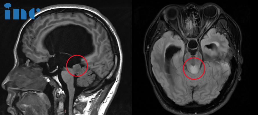 中脑顶盖胶质瘤示范手术影像