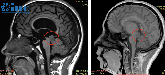 巴教授中脑顶盖胶质瘤示范手术MRI影像