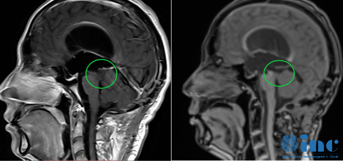 巴教授中脑顶盖胶质瘤示范手术后影像
