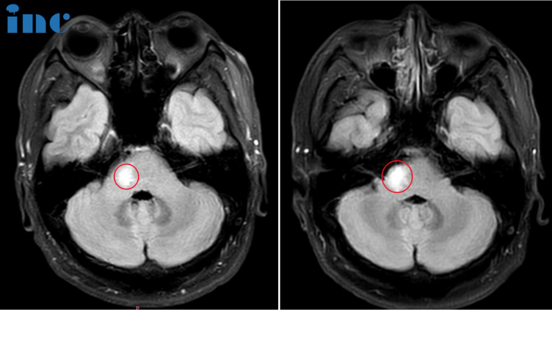 33岁男士-桥臂胶质瘤
