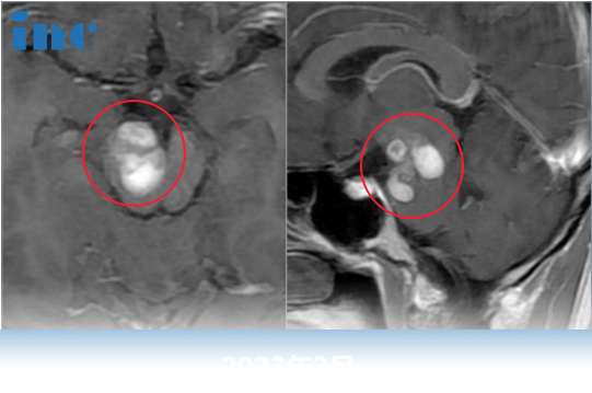 30岁年轻女性-脑干海绵状血管瘤