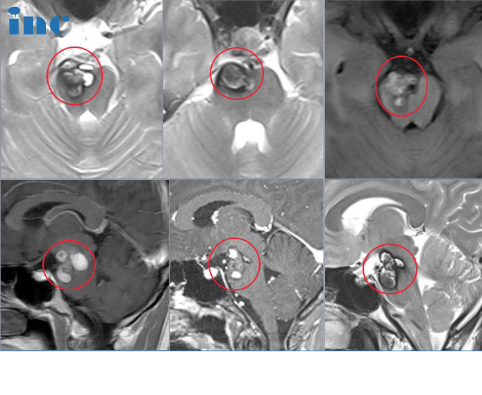30岁年轻女性-脑干海绵状血管瘤