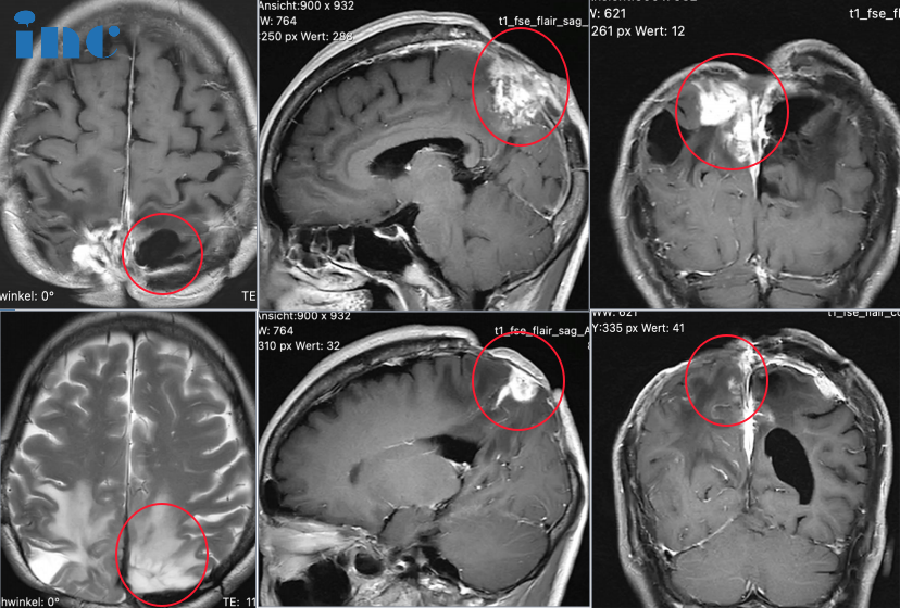 54岁女性-大脑镰旁脑膜瘤