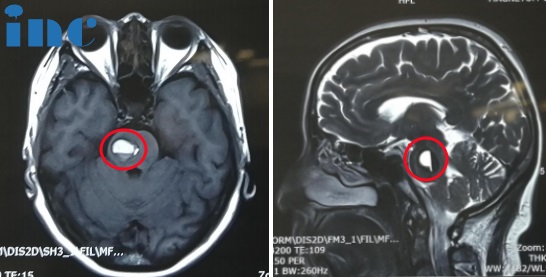 52岁女士-脑桥（右侧）海绵状血管瘤并出血