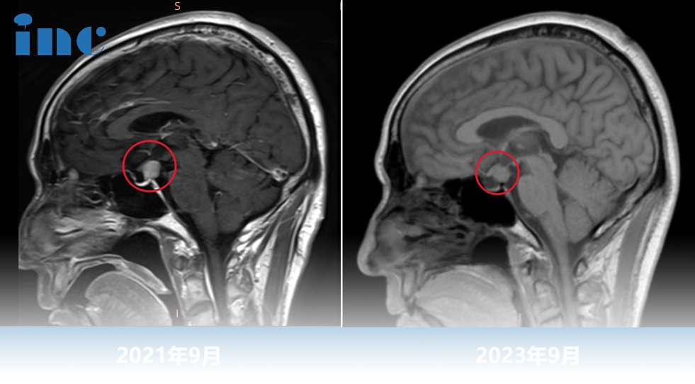 52岁男性-鞍区占位性病变