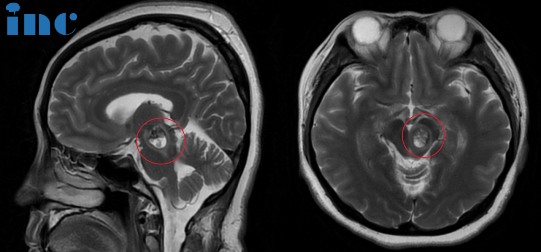脑干-中脑海绵状血管瘤影像