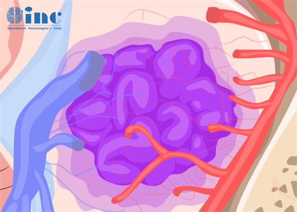 脑颞叶海绵状血管瘤手术后遗症
