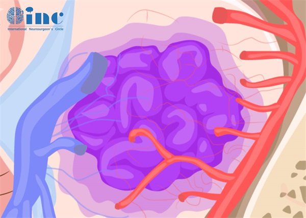 脑部右侧颞叶海绵状血管瘤