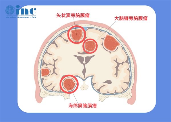 右顶叶脑膜瘤术后又化疗会复发吗