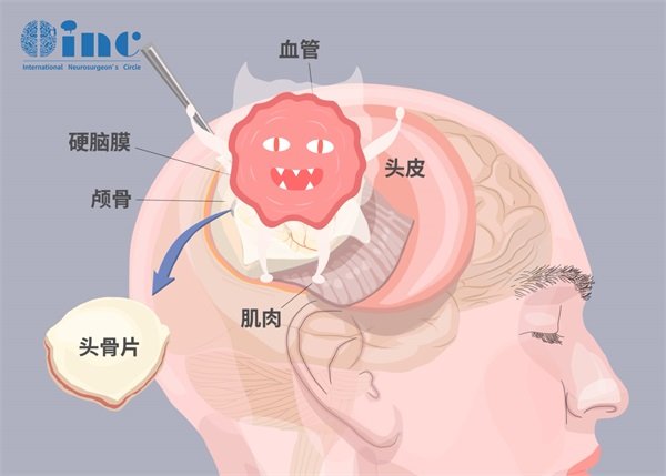 顶叶脑膜瘤手术难度高吗能活多久