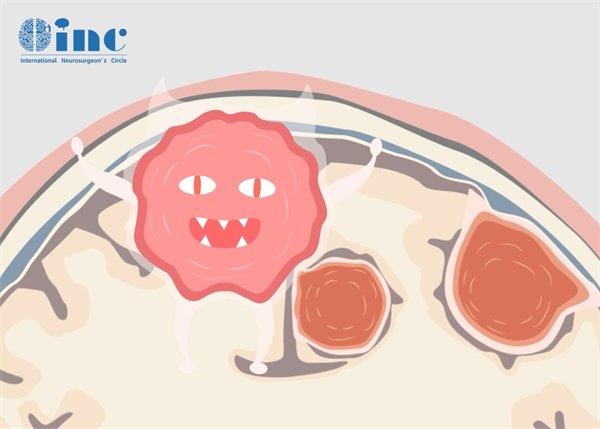 左侧顶叶海绵状血管瘤怎么治疗好？是什么病？