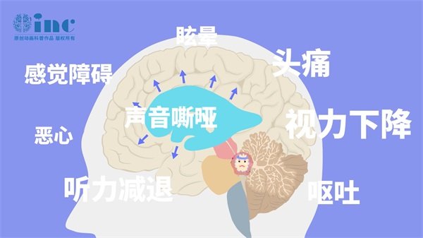 脑干胶质瘤出现手脚浮肿和吞咽困难