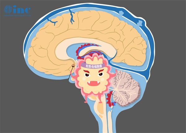 巨大小脑脑干胶质瘤能活多久？能治好吗？