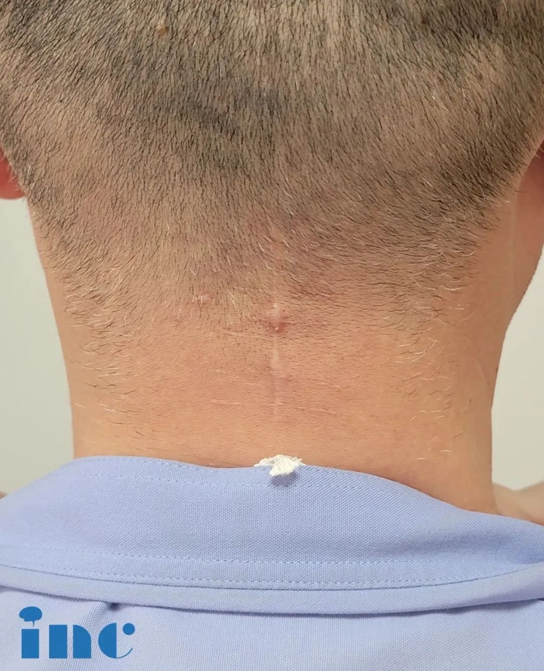 脊髓髓内肿瘤案例手术切口