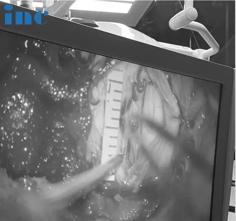 脊髓髓内肿瘤患者案例