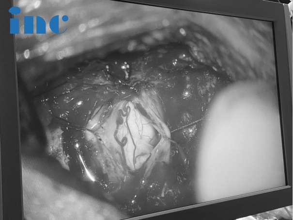 脊髓髓内肿瘤患者案例手术全切