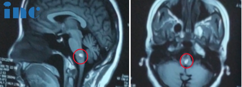 脑干延髓海绵状血管瘤患者三次出血