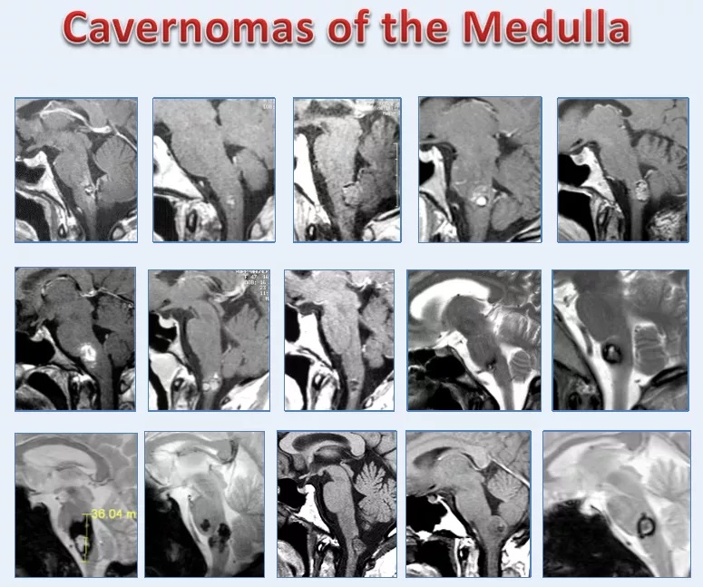 脑干延髓海绵状血管瘤——巴教授