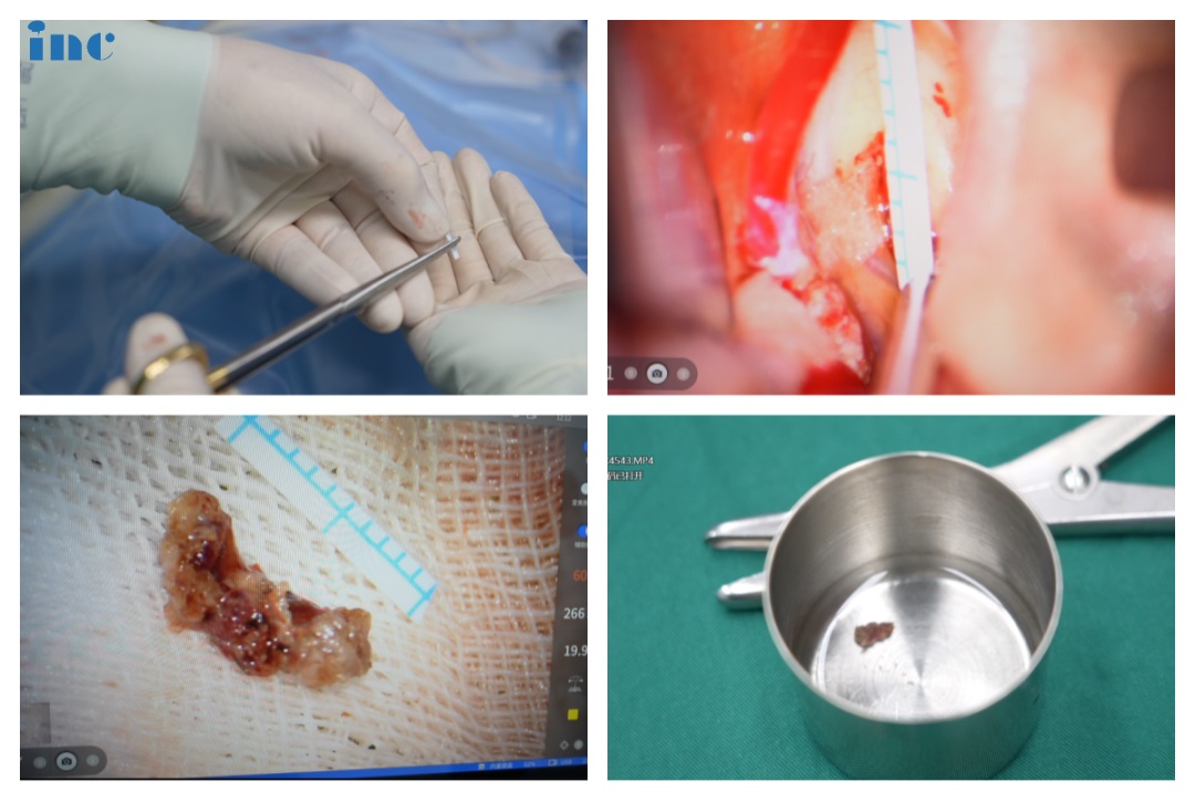 脑干延髓海绵状血管瘤