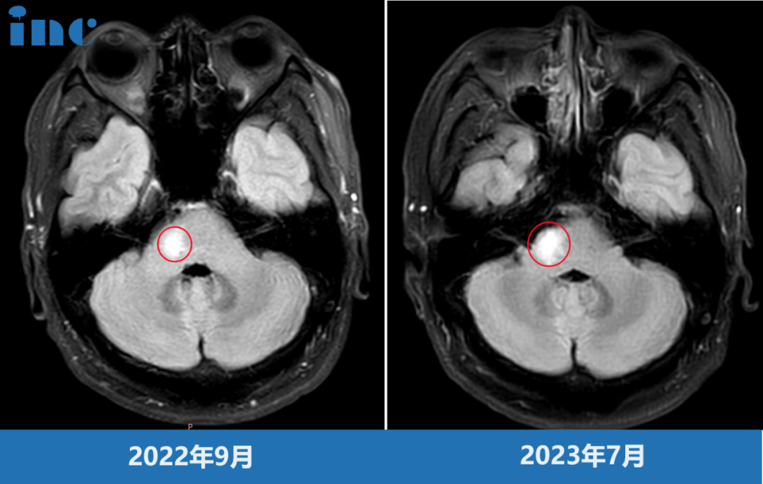 脑干-桥臂胶质瘤影像