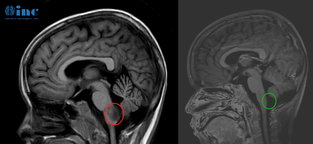 6岁男孩脑干-延髓毛细胞星形细胞瘤