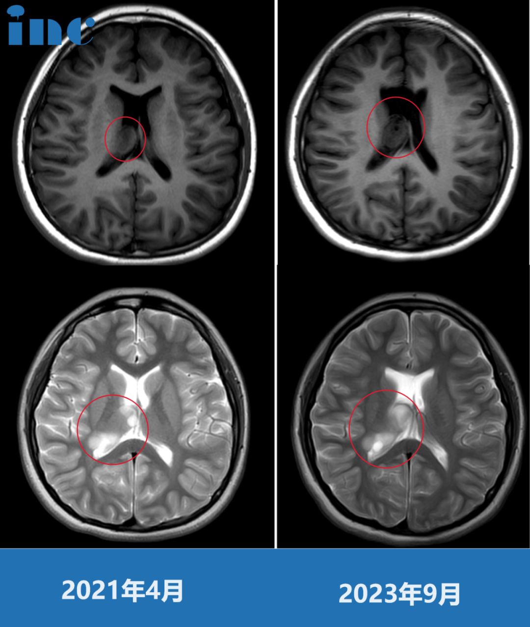 右侧侧脑室及室间孔胶质瘤