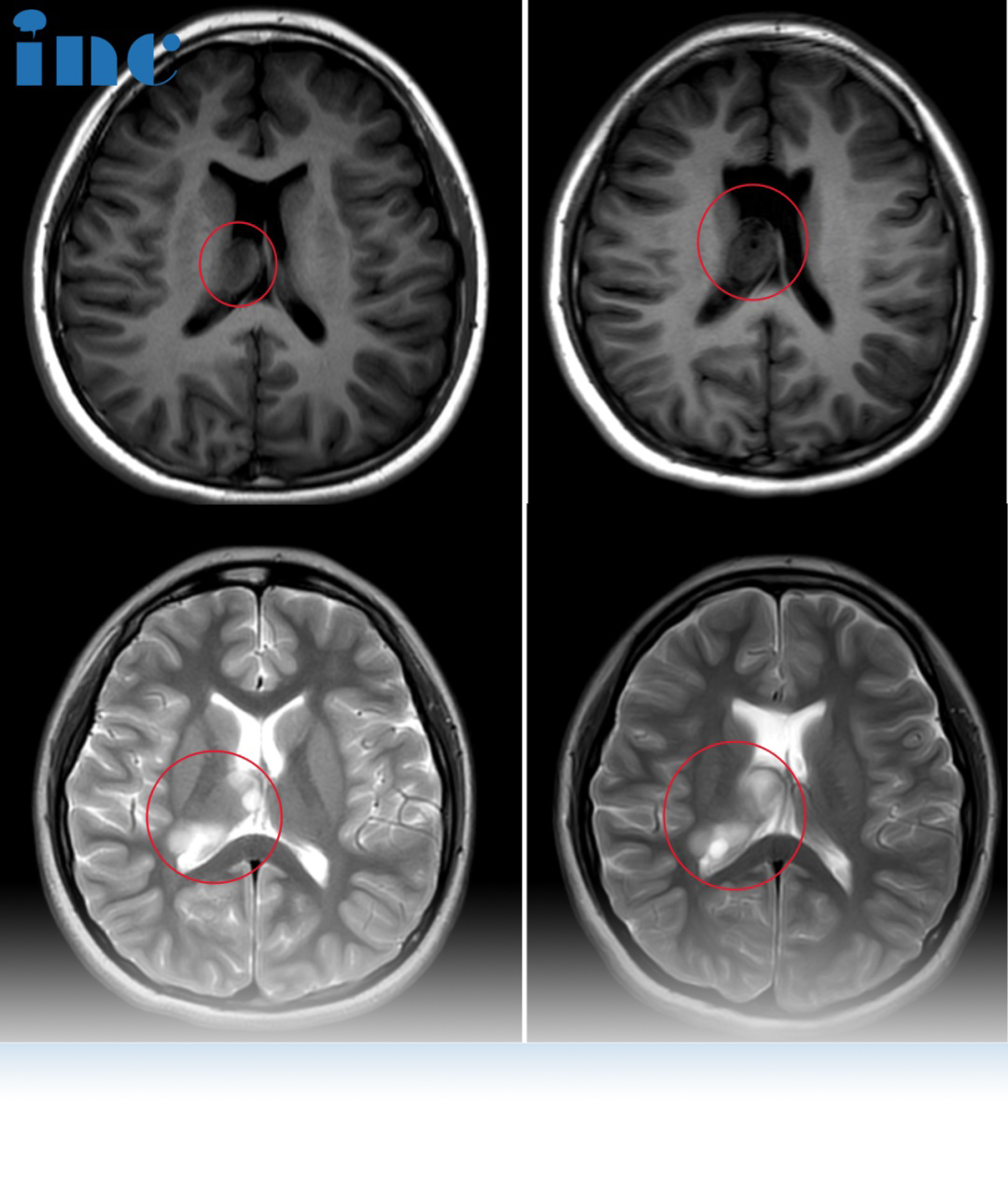 右侧侧脑室及室间孔<a href='/bingzhong/jiaozhiliu/' target='_blank'><u>胶质瘤</u></a>