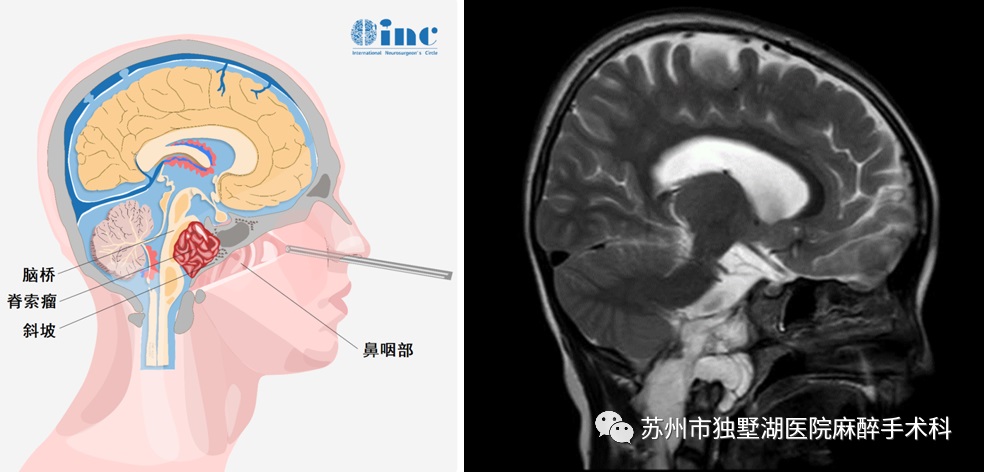 福洛里希教授手术