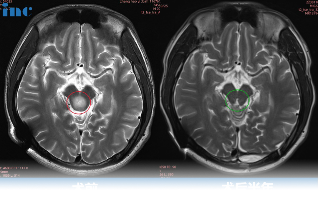 脑干<a href='/jibing/naojiaozhiliu/1803.html' target='_blank'><u>胶质瘤手术</u></a>治疗