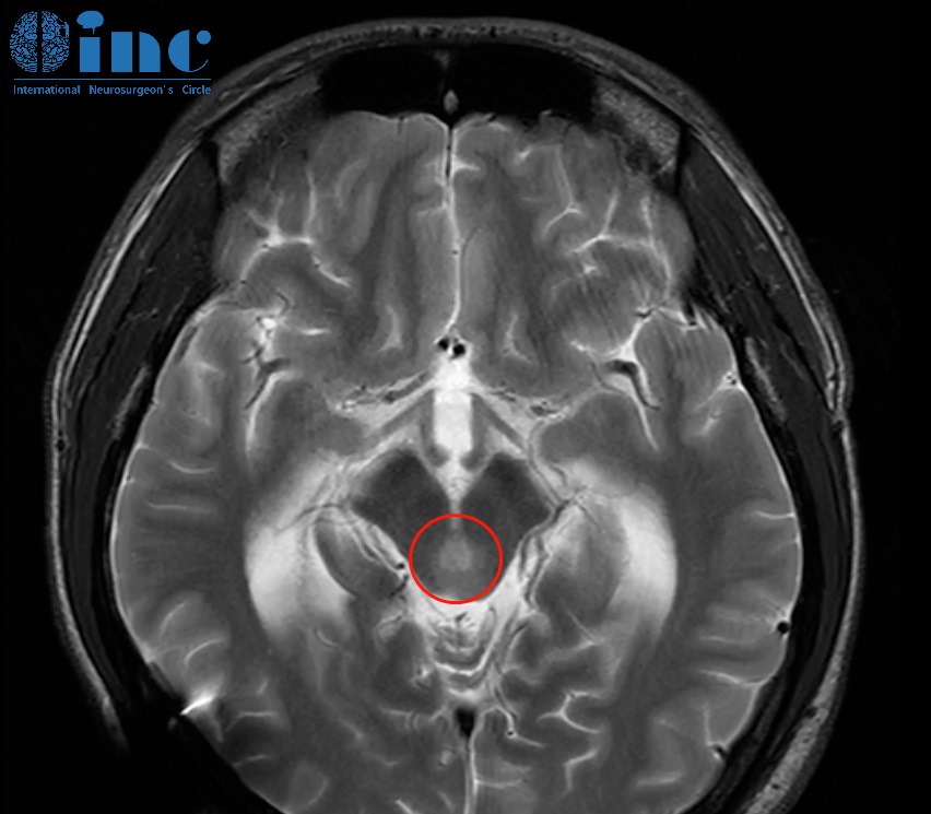 中脑顶盖胶质瘤治疗