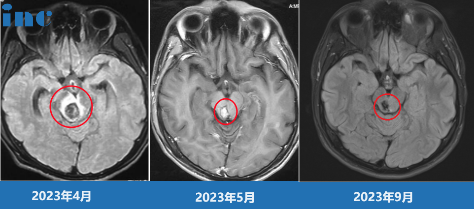 20岁男孩小峰——脑干-中脑血管畸形