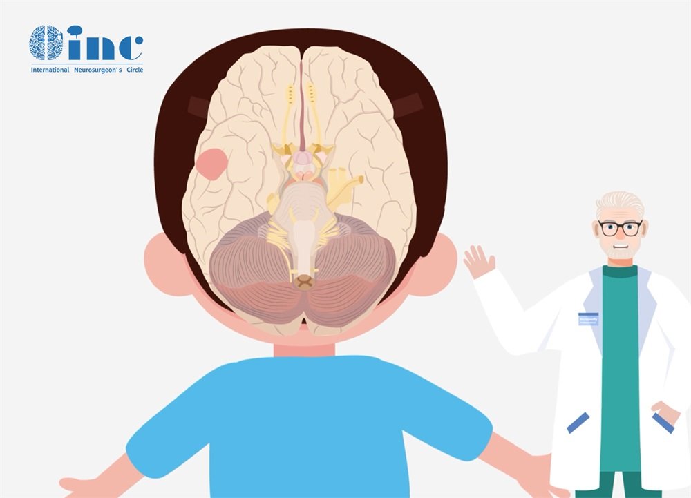 <a href='/bingzhong/xueguanliu/' target='_blank'><u>脑海绵状血管瘤</u></a>