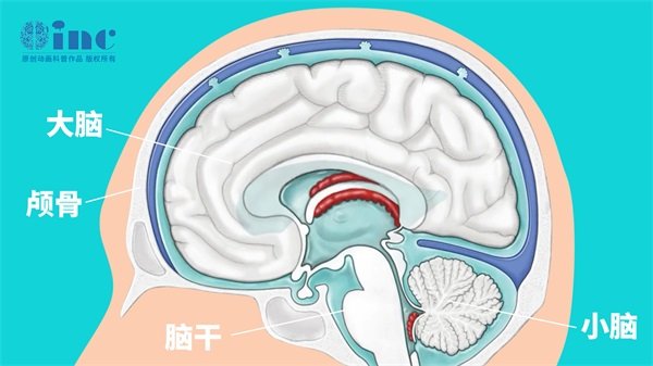 大脑松果体肿瘤切除成功