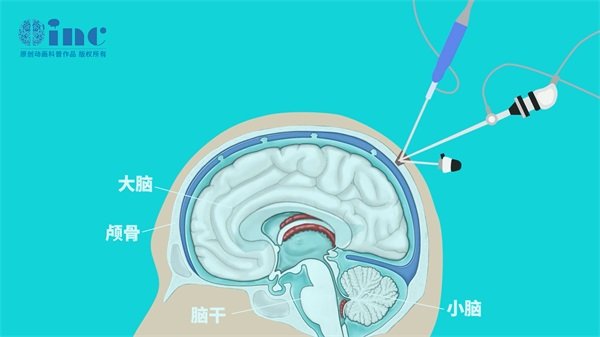 松果体区肿瘤的病因和鉴别方法